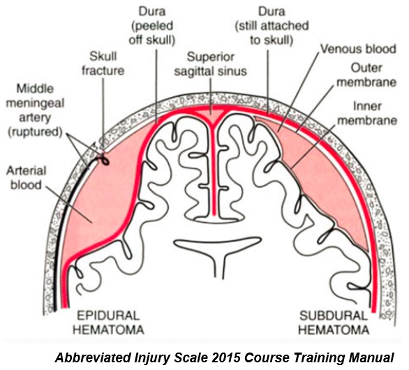 Injury head types of Head Injury